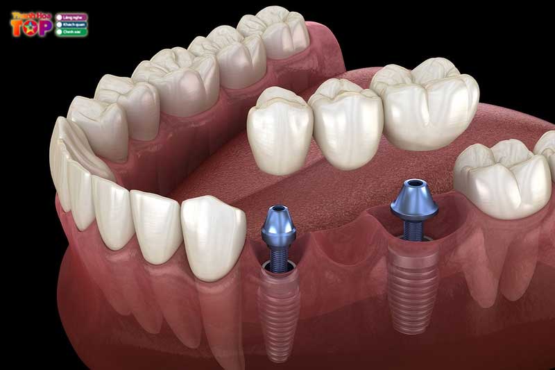 Cau-rang-su-giai-phap-phuc-hoi-nu-cuoi-tu-nhien-cho-nguoi-mat-rang-3