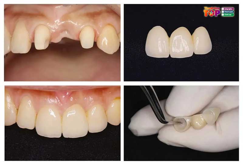 Cau-rang-su-giai-phap-phuc-hoi-nu-cuoi-tu-nhien-cho-nguoi-mat-rang-4